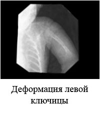 Deformation of the left clavicle